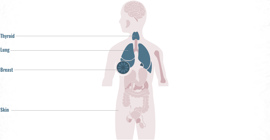 Distribution of RET gene fusions across primary tumor sites graphic